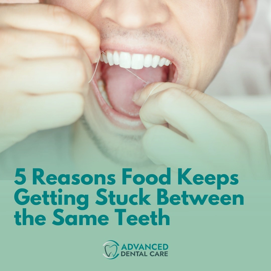 Person flossing upper teeth and text saying: “5 Reasons Food Keeps Getting Stuck Between the Same Teeth”